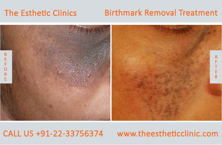 Birthmarks Removal Treatment before after photos in mumbai india (1)
